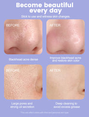 Portable Ultrasonic Facial Scraper Deep Cleansing Blackhead Remover and Pore Cleaner for Face and Nose